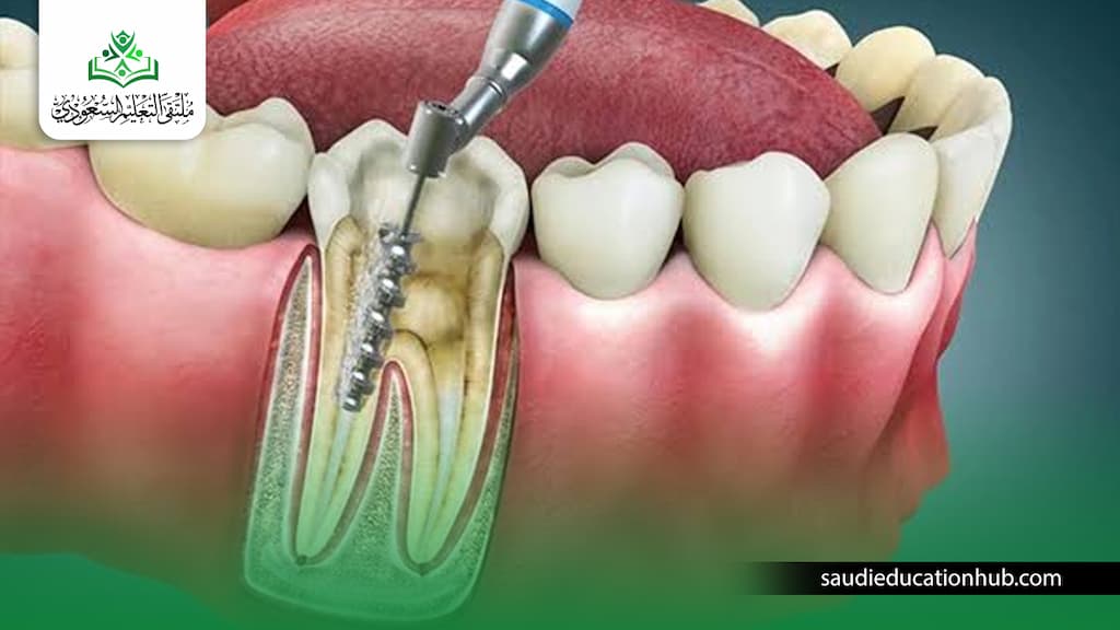 دراسة ماجستير علاج الجذور في مصر 